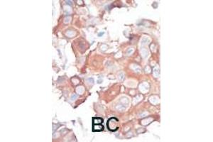 Formalin-fixed and paraffin-embedded human cancer tissue reacted with the primary antibody, which was peroxidase-conjugated to the secondary antibody, followed by AEC staining. (MAP3K1 抗体  (C-Term))
