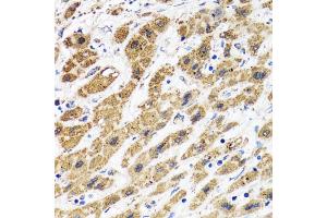 Immunohistochemistry of paraffin-embedded human liver cancer using HAPLN1 antibody (ABIN5973979) at dilution of 1/100 (40x lens). (HAPLN1 抗体)