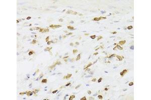 Immunohistochemistry of paraffin-embedded Human gastric cancer using LSP1 Polyclonal Antibody at dilution of 1:100 (40x lens). (LSP1 抗体)