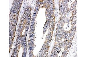 IHC-P: EphA1 antibody testing of human colon cancer tissue (EPHA1 抗体  (C-Term))