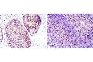 Immunohistochemical analysis of paraffin-embedded prostate cancer tissues (left) and tonsil tissues (right) using EEF2 mouse mAb with DAB staining.