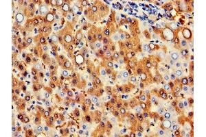IHC image of ABIN7154972 diluted at 1:300 and staining in paraffin-embedded human liver cancer performed on a Leica BondTM system. (Hemoglobin Subunit beta 抗体  (AA 1-147))