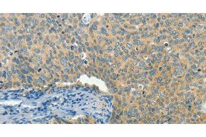 Immunohistochemistry of paraffin-embedded Human cervical cancer tissue using BCAT1 Polyclonal Antibody at dilution 1:50