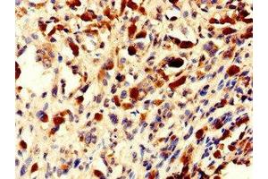 Immunohistochemistry of paraffin-embedded human melanoma using ABIN7154802 at dilution of 1:100 (NHP2 抗体  (AA 1-153))