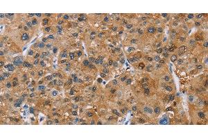 Immunohistochemistry of paraffin-embedded Human liver cancer tissue using NCR3 Polyclonal Antibody at dilution 1:40 (NCR3 抗体)