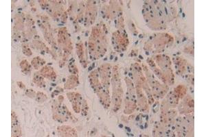 Detection of MYH16 in Human Esophagus cancer Tissue using Polyclonal Antibody to Myosin Heavy Chain 16 (MYH16) (MYH16 抗体  (AA 209-469))