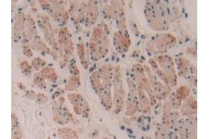 Detection of MYH16 in Human Esophagus cancer Tissue using Polyclonal Antibody to Myosin Heavy Chain 16 (MYH16)