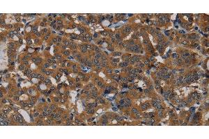 Immunohistochemistry of paraffin-embedded Human thyroid cancer tissue using PDE5A Polyclonal Antibody at dilution 1:50 (PDE5A 抗体)