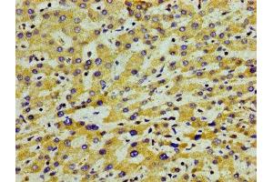 Immunohistochemistry of paraffin-embedded human liver cancer using ABIN7144407 at dilution of 1:100 (APOA5 抗体  (AA 260-366))