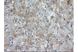 Immunohistochemical staining of paraffin-embedded Human liver tissue using anti-BIRC5 mouse monoclonal antibody. (Survivin 抗体)