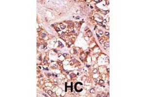 Formalin-fixed and paraffin-embedded human hepatocellular carcinoma tissue reacted with the BIK polyclonal antibody  , which was peroxidase-conjugated to the secondary antibody, followed by AEC staining. (BIK 抗体  (N-Term))