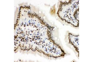 Immunohistochemistry (Paraffin-embedded Sections) (IHC (p)) image for anti-Hypoxia Inducible Factor 1, alpha Subunit (Basic Helix-Loop-Helix Transcription Factor) (HIF1A) (AA 703-732), (C-Term) antibody (ABIN3043841) (HIF1A 抗体  (C-Term))