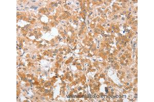 Immunohistochemistry of Human brain  using PLA2G4A Polyclonal Antibody at dilution of 1:40 (PLA2G4A 抗体)
