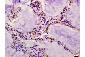 Formalin-fixed and paraffin embedded human colon carcinoma labeled with Anti-CD162 Polyclonal Antibody, Unconjugated (ABIN679298) at 1:200 followed by conjugation to the secondary antibody and DAB staining (SELPLG 抗体  (AA 251-350))