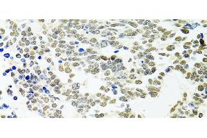 Immunohistochemistry of paraffin-embedded Human lung cancer using PPP4C Polyclonal Antibody at dilution of 1:100 (40x lens). (PPP4C 抗体)