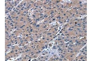 The image on the left is immunohistochemistry of paraffin-embedded Human liver cancer tissue using ABIN7130871(RGS11 Antibody) at dilution 1/20, on the right is treated with fusion protein. (RGS11 抗体)