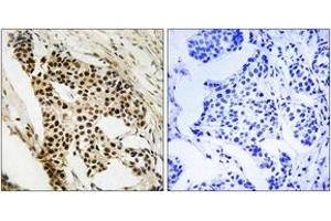 Immunohistochemistry analysis of paraffin-embedded human breast carcinoma tissue, using MAPKAPK2 (Ab-272) Antibody. (MAPKAP Kinase 2 抗体  (AA 238-287))