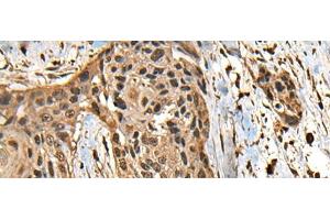 Immunohistochemistry of paraffin-embedded Human esophagus cancer tissue using CCDC113 Polyclonal Antibody at dilution of 1:65(x200) (CCDC113 抗体)