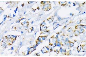 Immunohistochemistry of paraffin-embedded Human breast cancer using HK2 Polyclonal Antibody at dilution of 1:200 (40x lens). (Hexokinase 2 抗体)