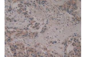 IHC-P analysis of Human Breast Cancer Tissue, with DAB staining. (CIRBP 抗体  (AA 1-172))
