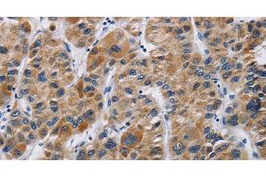 Immunohistochemistry of paraffin-embedded Human liver cancer using IFNGR2 Polyclonal Antibody at dilution of 1:40 (IFNGR2 抗体)