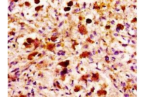 IHC image of ABIN7158974 diluted at 1:100 and staining in paraffin-embedded human melanoma performed on a Leica BondTM system. (MASP2 抗体  (AA 189-314))