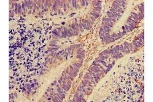 Immunohistochemistry of paraffin-embedded human ovarian cancer using ABIN7142793 at dilution of 1:100 (RPL28 抗体  (AA 2-137) (Biotin))