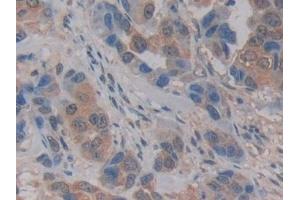 Detection of KLK2 in Human Breast cancer Tissue using Polyclonal Antibody to Kallikrein 2 (KLK2)
