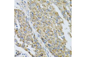 Immunohistochemistry of paraffin-embedded human lung cancer using CYP1A1 antibody (ABIN5971186) at dilution of 1/100 (40x lens). (CYP1A1 抗体)