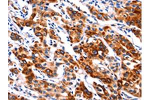 The image on the left is immunohistochemistry of paraffin-embedded Human lung cancer tissue using ABIN7192314(SEPT4 Antibody) at dilution 1/50, on the right is treated with synthetic peptide. (Septin 4 抗体)