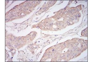 Immunohistochemical analysis of paraffin-embedded rectum cancer tissues using CD10 mouse mAb with DAB staining. (MME 抗体  (AA 52-246))