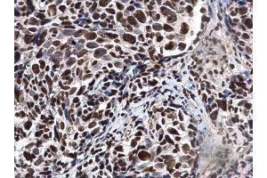 IHC-P Image Ku70 antibody detects Ku70 protein at nucleus in human cervical cancer by immunohistochemical analysis.