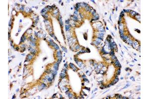 Anti- Grp75 Picoband antibody,IHC(P) IHC(P): Human Intestinal Cancer Tissue (HSPA9 抗体  (C-Term))