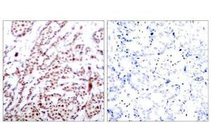 Immunohistochemical analysis of paraffin-embedded human breast carcinoma tissue using ATF2(Phospho-Thr73 or 55) Antibody(left) or the same antibody preincubated with blocking peptide(right). (ATF2 抗体  (pThr73))