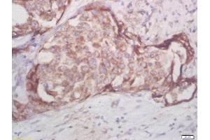 Formalin-fixed and paraffin embedded human breast cancer labeled with Rabbit Anti-AKT1/2/3 (Thr305/308/309) Polyclonal Antibody, Unconjugated (ABIN756052) at 1:200 followed by conjugation to the secondary antibody and DAB staining (AKT 1/2/3 抗体  (pThr305, pThr308, pThr309))