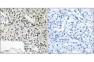 Immunohistochemistry analysis of paraffin-embedded human breast carcinoma, using TCEAL4 Antibody. (TCEAL4 抗体  (AA 166-215))