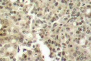 Immunohistochemistry (IHC) analyzes of PKC delta antibody in paraffin-embedded human breast carcinoma tissue. (PKC delta 抗体)