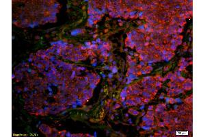 Formalin-fixed and paraffin embedded human lung carcinoma labeled with Anti-CD8B Polyclonal Antibody, Unconjugated (ABIN1387300) at 1:200 followed by secondary antibody was Goat Anti-Rabbit IgG, Cy3 conjugated used at 1:200 dilution for 40 minutes at (CD8B 抗体  (AA 51-150))