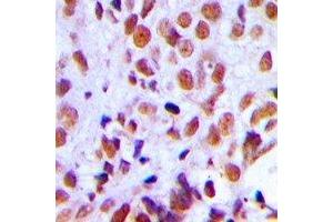 Immunohistochemical analysis of RAD21 staining in human breast cancer formalin fixed paraffin embedded tissue section. (RAD21 抗体  (C-Term))