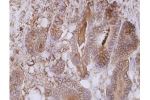 Immunohistochemistry staining of colorectal carcinoma (paraffin-embedded sections) with anti-human CD66e (CB30). (CEACAM5 抗体)