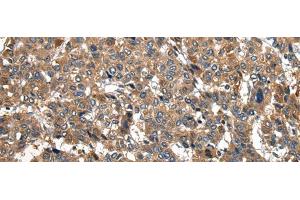 Immunohistochemistry of paraffin-embedded Human liver cancer tissue using PIWIL2 Polyclonal Antibody at dilution of 1:30(x200) (PIWIL2 抗体)