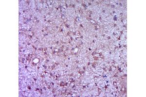 Paraformaldehyde-fixed, paraffin embedded human brain glioma, Antigen retrieval by boiling in sodium citrate buffer (pH6. (G-CSF 抗体  (AA 155-198))