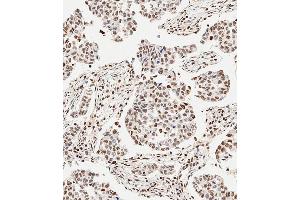 Immunohistochemical analysis of paraffin-embedded Human breast carcinoma tissue using (ABIN6243675 and ABIN6577401) performed on the Leica® BOND RXm. (GLI2 抗体  (C-Term))