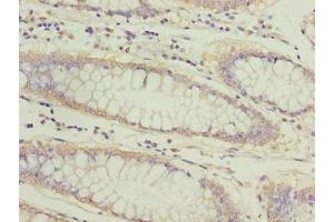 Immunohistochemistry of paraffin-embedded human colon cancer using ABIN7144813 at dilution of 1:100 (ATL2 抗体  (AA 1-300))