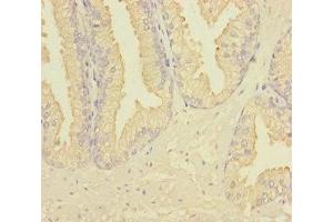 Immunohistochemistry of paraffin-embedded human prostate cancer using ABIN7167274 at dilution of 1:100 (RAB27B 抗体  (AA 1-218))