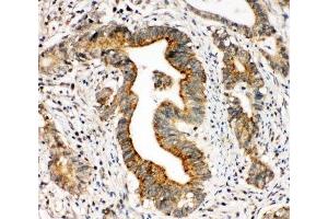 IHC-P: Integrin alpha 3 antibody testing of human intestinal cancer tissue (ITGA3 抗体  (N-Term))