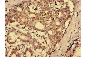 Immunohistochemistry analysis of human breast cancer using ABIN7168686 at dilution of 1:100 (SFRP4 抗体  (AA 293-346))