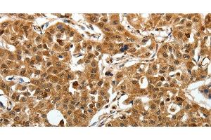 Immunohistochemistry of paraffin-embedded Human lung cancer using SOX-13 Polyclonal Antibody at dilution of 1:50 (SOX13 抗体)