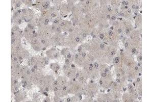 ABIN6267594 at 1/200 staining human liver cancer tissue sections by IHC-P. (MEK1 抗体  (pSer221))
