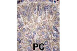 Formalin-fixed and paraffin-embedded human prostate carcinoma tissue reacted with CDH3 polyclonal antibody  , which was peroxidase-conjugated to the secondary antibody, followed by DAB staining. (P-Cadherin 抗体  (C-Term))